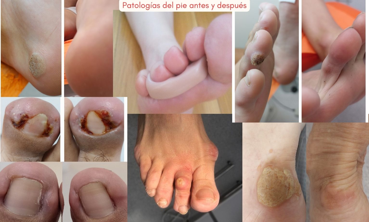 Patologías del pie